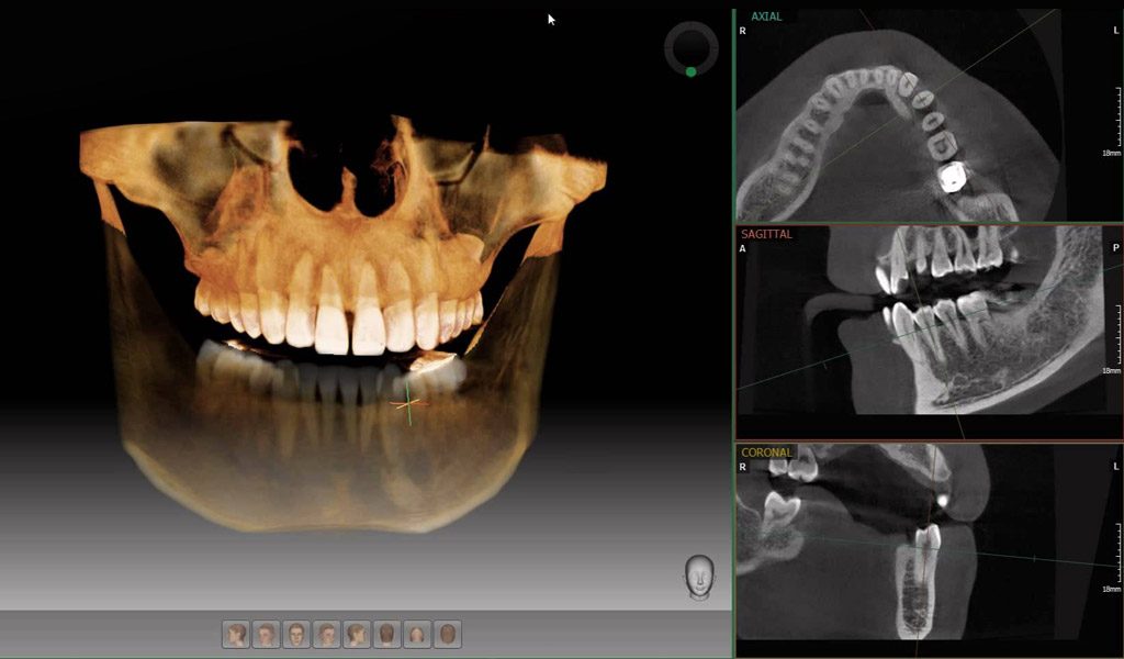Dentadura fijada con implantes dentales en Santa Coloma de Gramenet