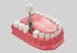Implantes dentales de carga inmediata en Santa Coloma de Gramenet