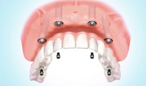 implantes dentales Santa Coloma de Gramenet