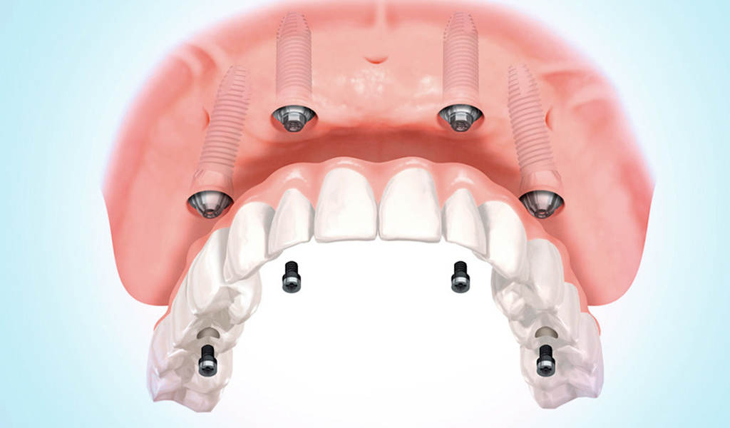 implantes dentales Santa Coloma de Gramenet