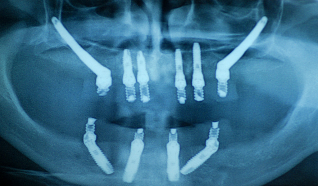 implantes dentales en Santa Coloma de Gramenet