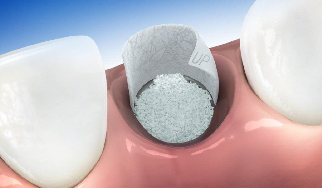 implantes dentales en Santa Coloma de Gramenet