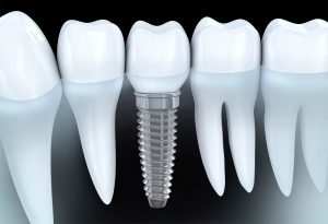 Implantología dental en Santa Coloma de Gramenet