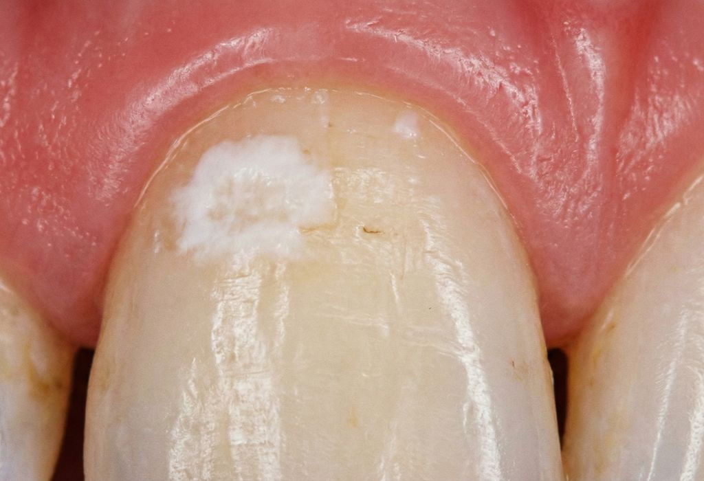Manchas Blancas En Los Dientes Al Quitar Brackets Se Quitan Manchas Blancas En Los Dientes Al Quitar Brackets Se Quitan