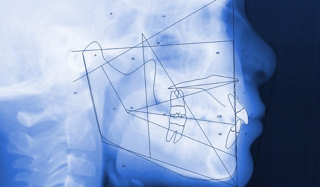 Ortodoncia invisible en Santa Coloma de Gramenet